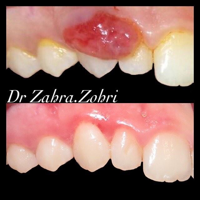 استفاده از لیزر در دندانپزشکی در مطب دکتر زهرا ظهری متخصص جراحی لثه و ایمپلنت و لیزر در دندانپزشکی